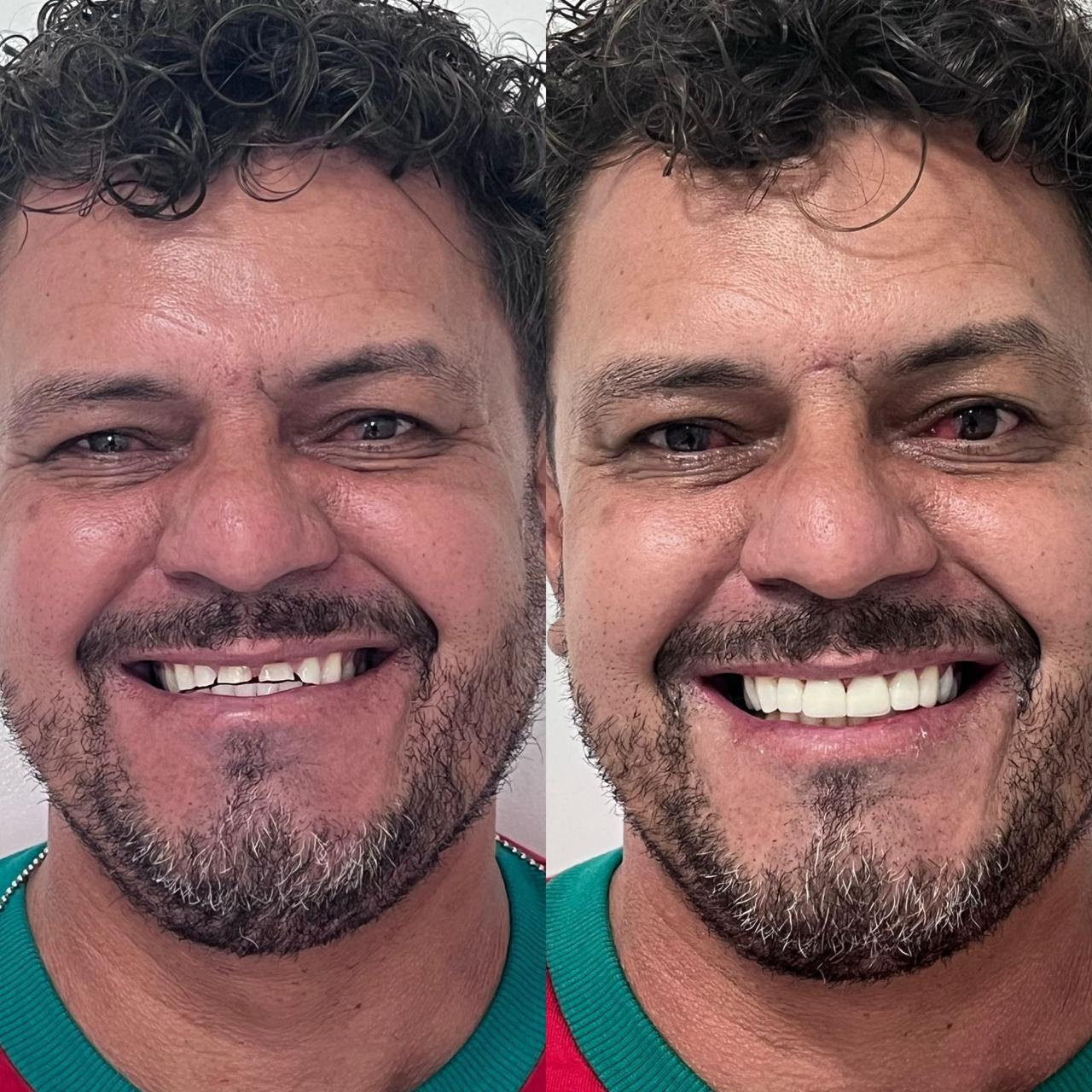 Antes do Protocolo Fixo